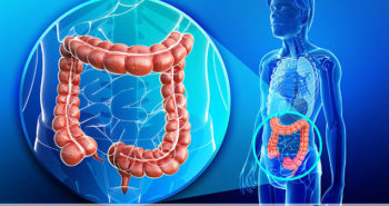Câncer de intestino - Por Dr Fabio Atui - Cirurgia do Aparelho Digestivo e Coloproctologista