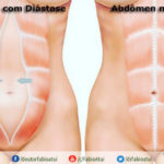 Diástase reto abdominal - Por Dr Fabio Atui - Cirurgia do Aparelho Digestivo e Coloproctologista